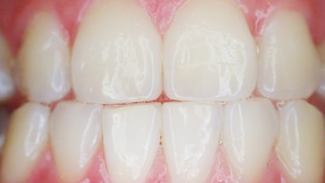 cosa-sono-le-tasche-gengivali