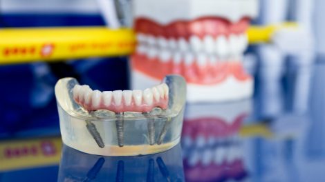 protesi-fissa-toronto-bridge