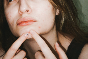 Una ragazza preme con i due indici un brufolo sul mento