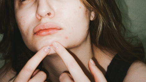 Una ragazza preme con i due indici un brufolo sul mento