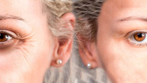 Il prima e il dopo di un trattamento di medicina estetica per la rimozione delle rughe intorno agli occhi